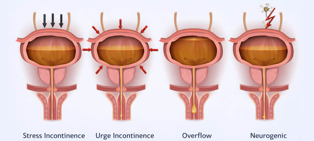 Bladder & Voiding Disorders