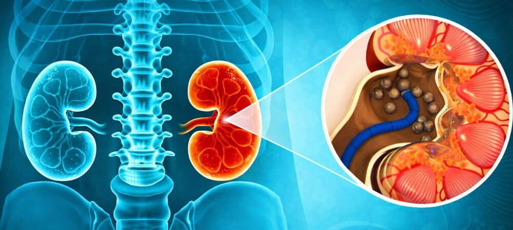Kidney Stone Treatment
