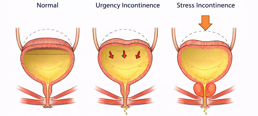 Urinary Incontinence